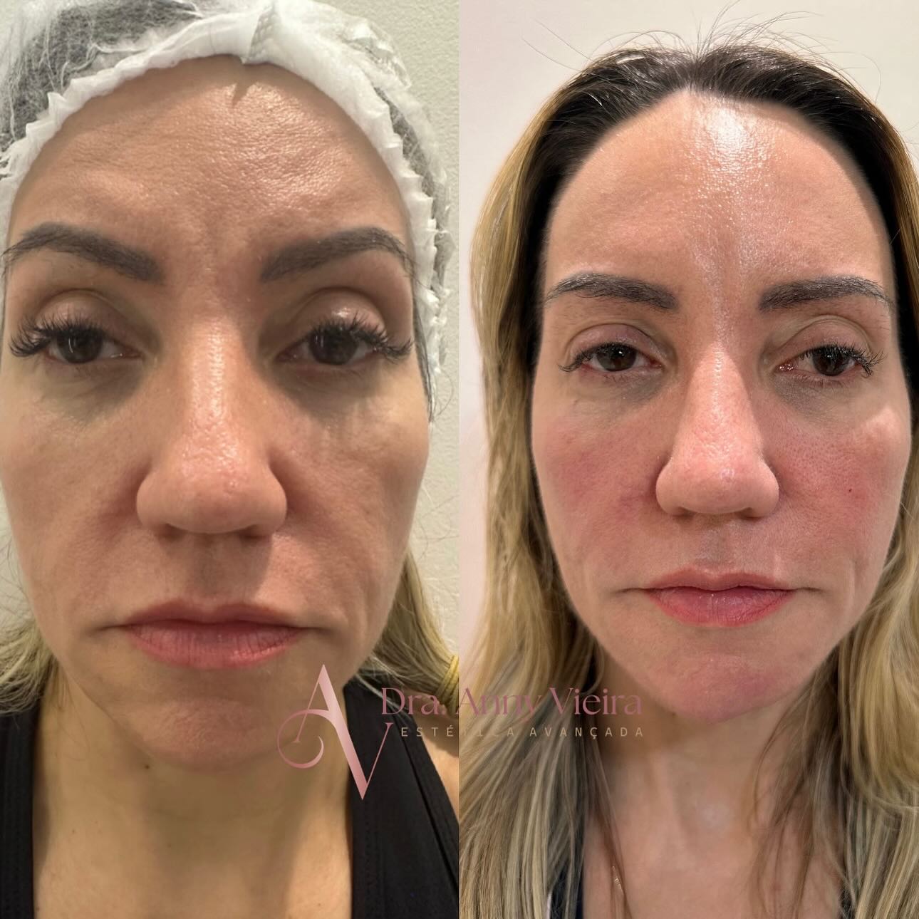 Botox no Centro de Niterói - RJ | Clínica Dra Anny Vieira