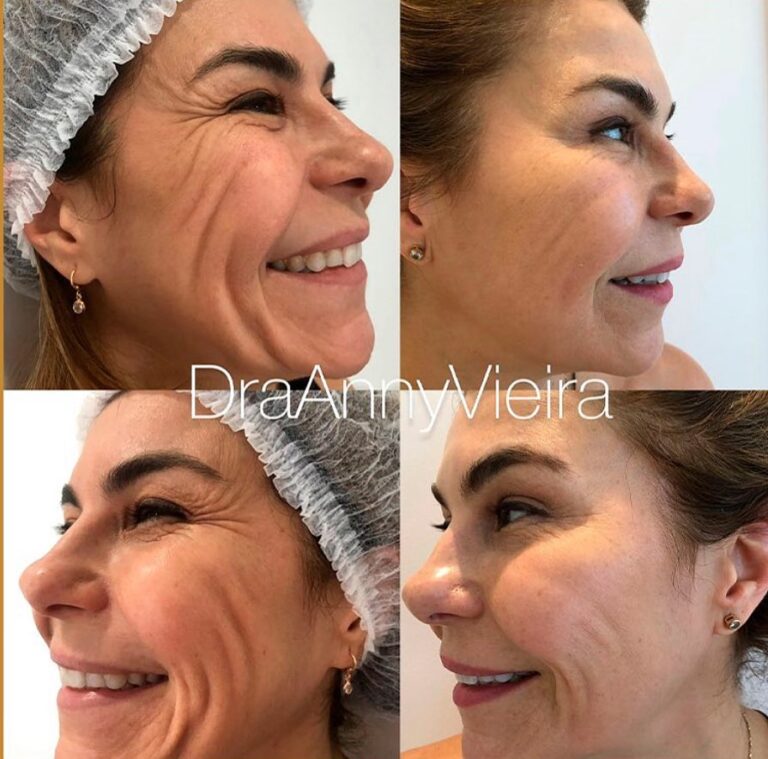 Antes e depois
