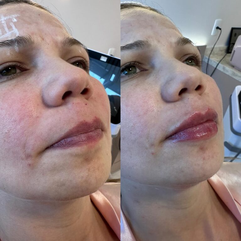 Antes e depois