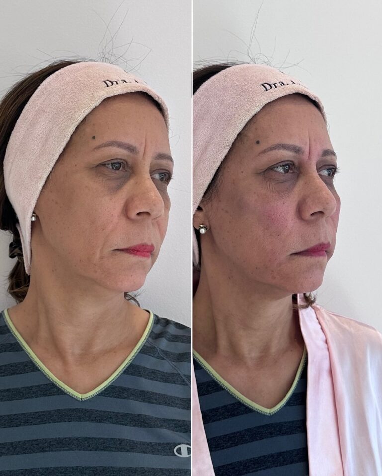 Antes e depois