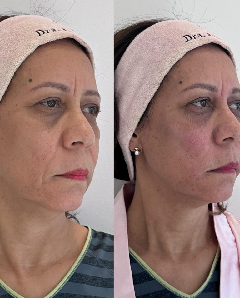 Antes e depois