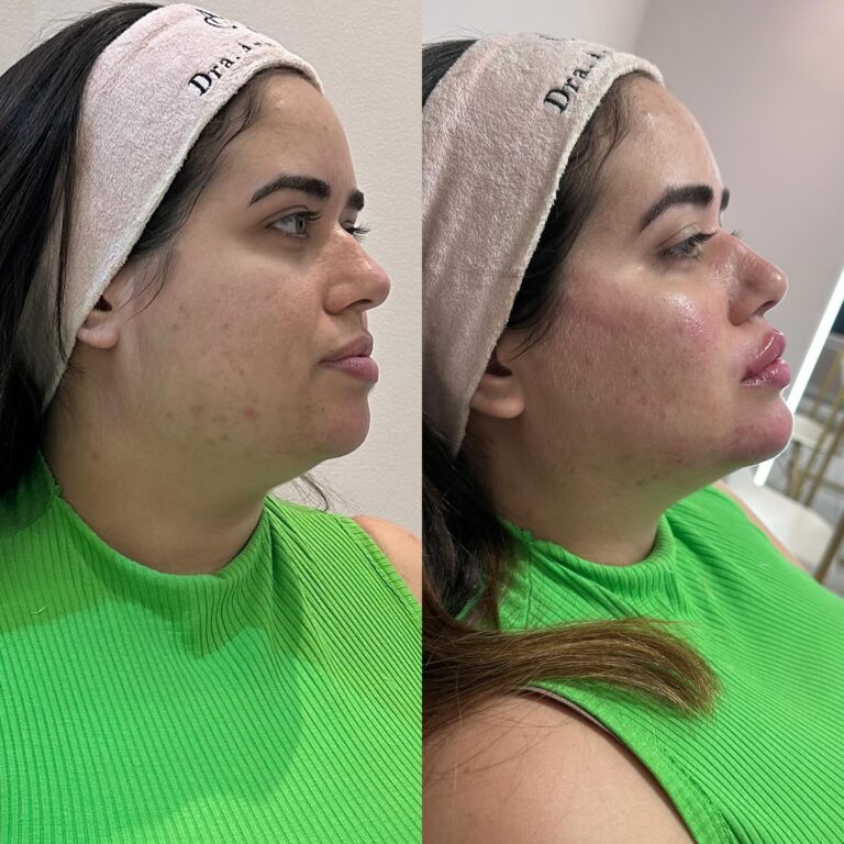 Antes e depois