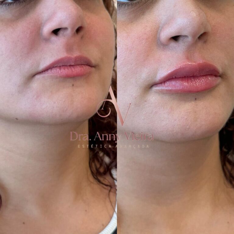 Antes e depois