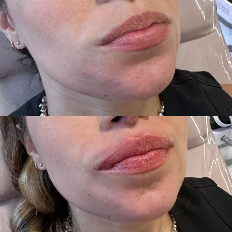 Antes e depois