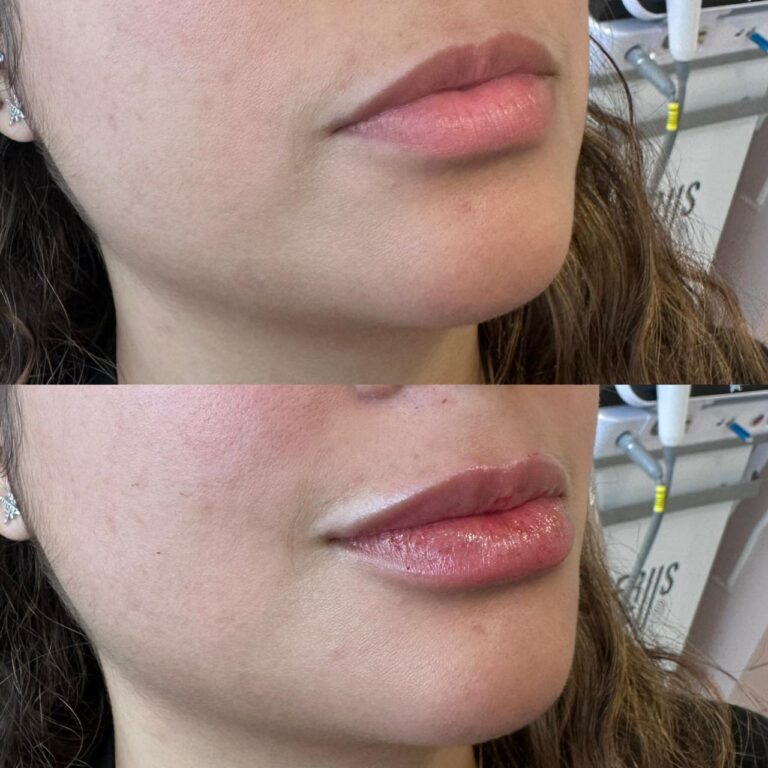 Antes e depois