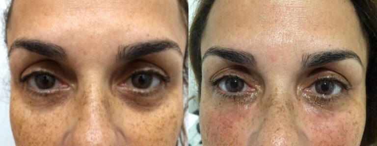 Antes e depois