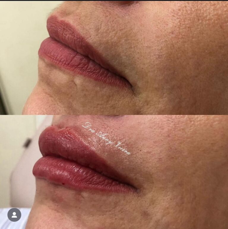 Antes e depois