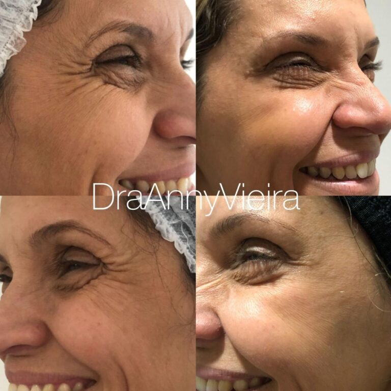 Antes e depois