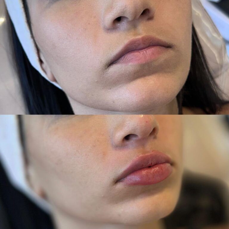 Antes e depois