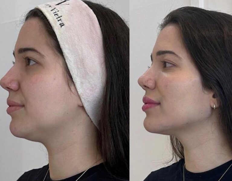 Antes e depois
