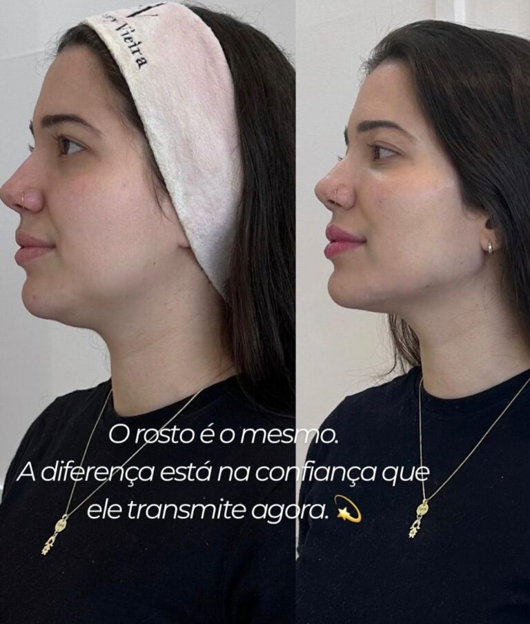 Antes e depois
