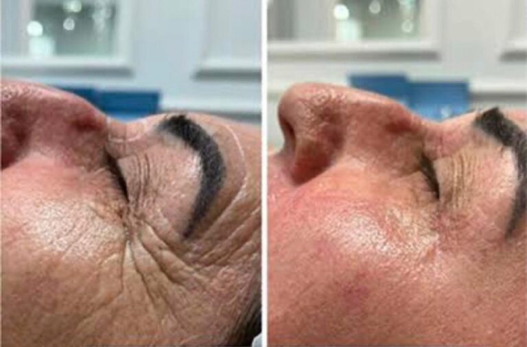 Antes e depois · Clínica Dra Anny Vieira | Harmonização Facial e Rejuvenescimento — salao em Centro, Niterói - RJ