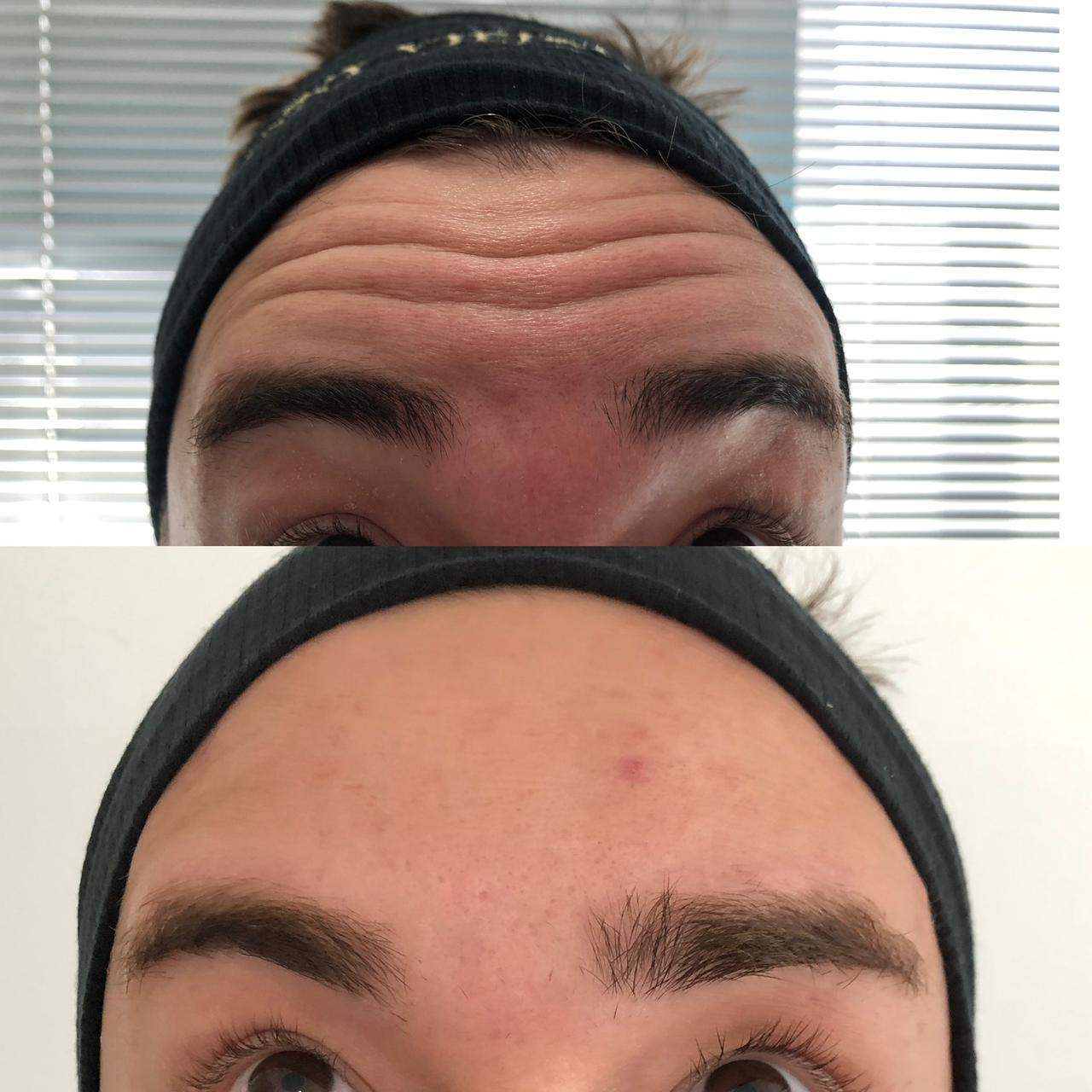 Botox no Centro de Niterói - RJ | Clínica Dra Anny Vieira
