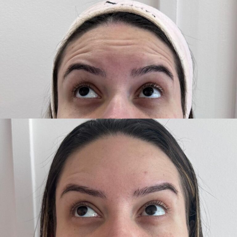Antes e depois