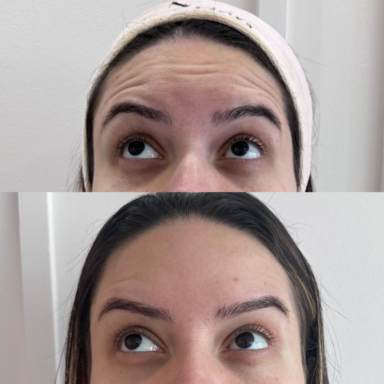 Botox no Centro de Niterói - RJ | Clínica Dra Anny Vieira