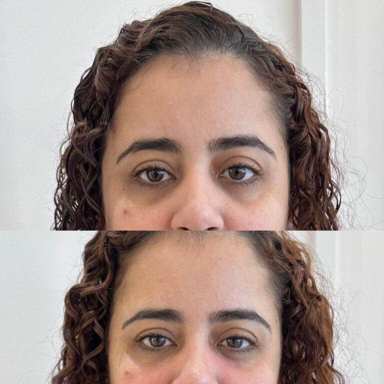 Antes e depois