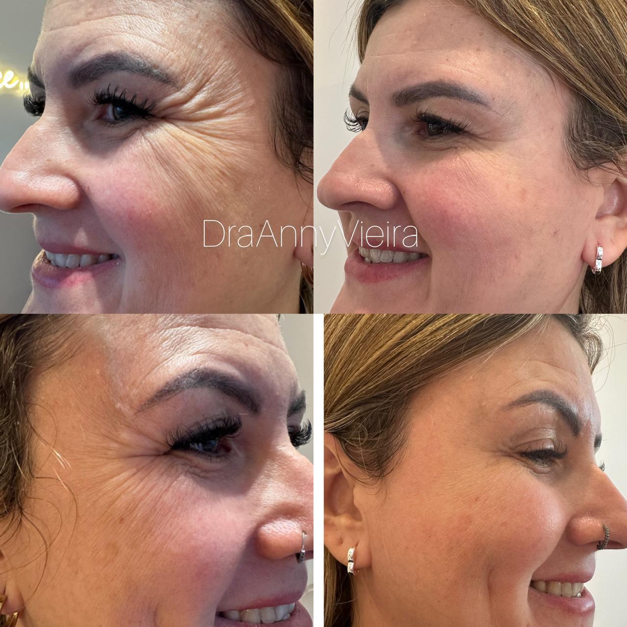 Botox no Centro de Niterói - RJ | Clínica Dra Anny Vieira