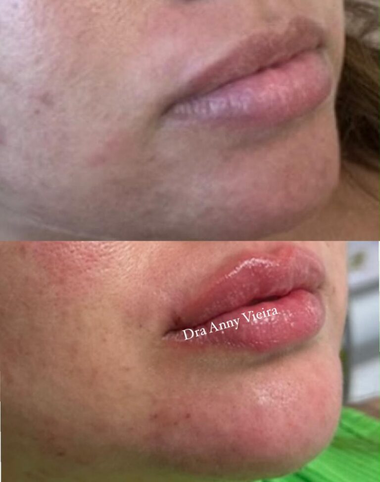 Antes e depois