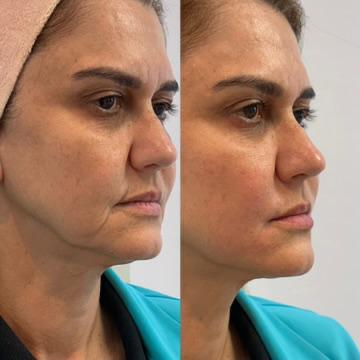 Antes e depois