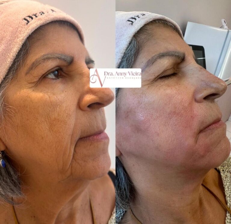 Antes e depois