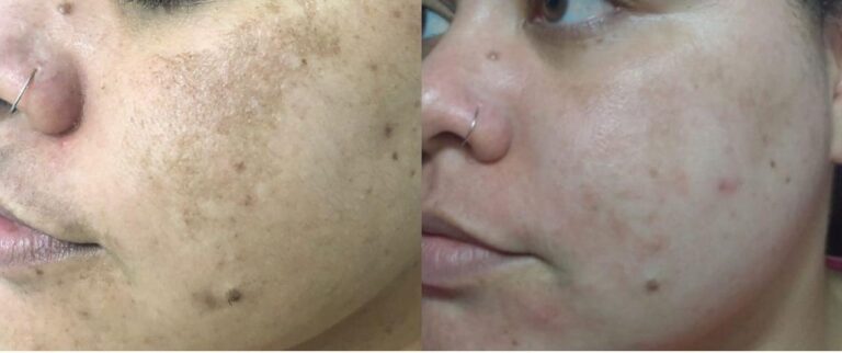 Antes e depois