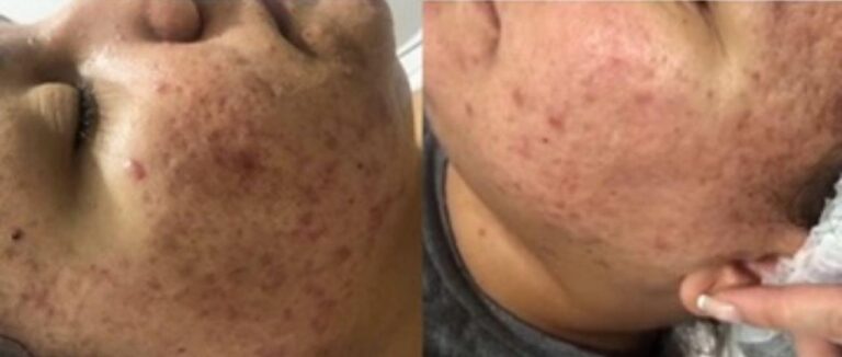 Antes e depois