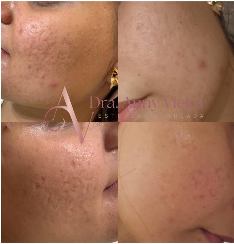 Antes e depois