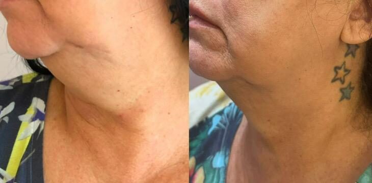 Antes e depois