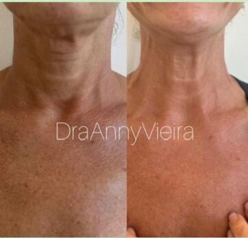 Antes e depois