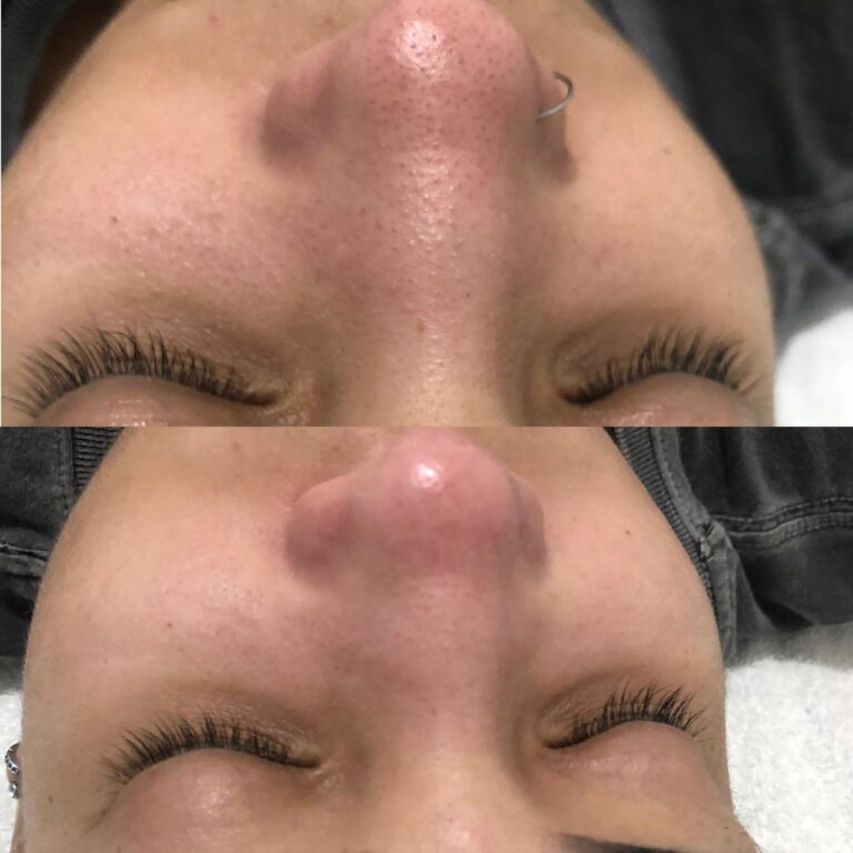 Antes e depois
