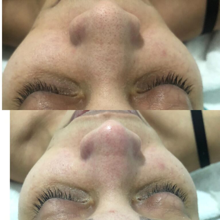 Antes e depois