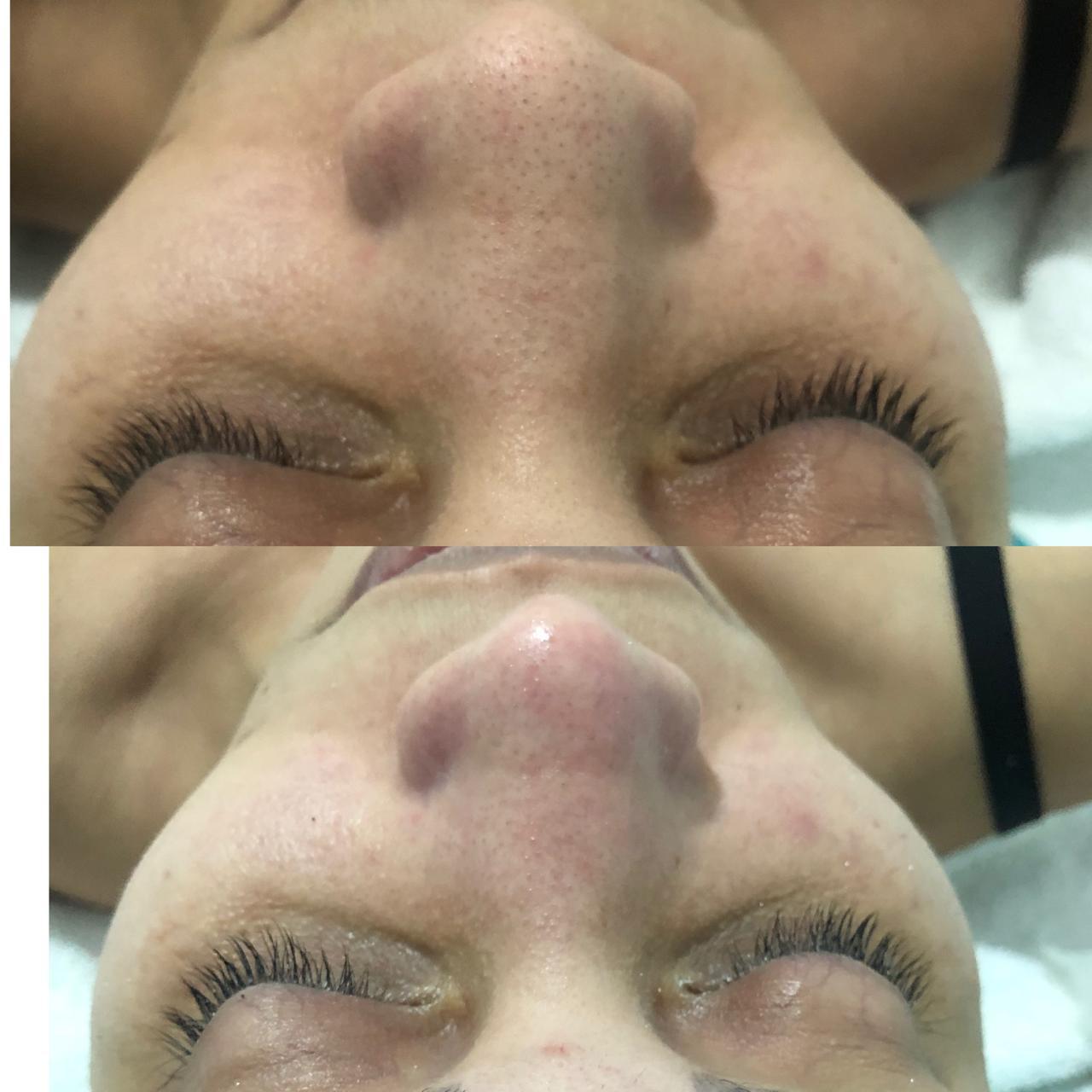 Limpeza de pele no Centro de Niterói - RJ | Clinica Dra Anny Vieira