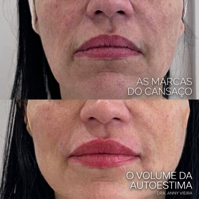 Como a perfiloplastia redefine o perfil facial no Centro de Niterói